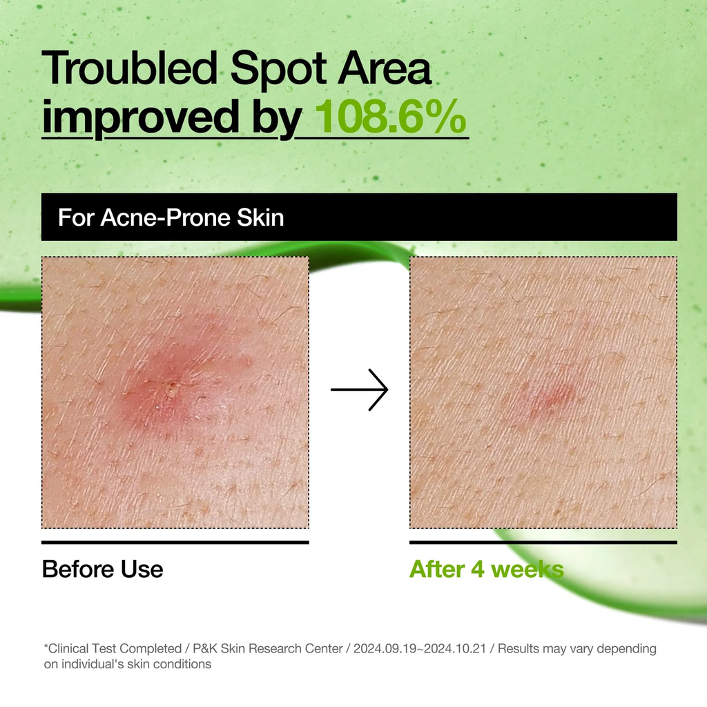 Before and After usage of Anua Azelaic Acid Serum + Dr. Althea 345 Relief Cream Bundle