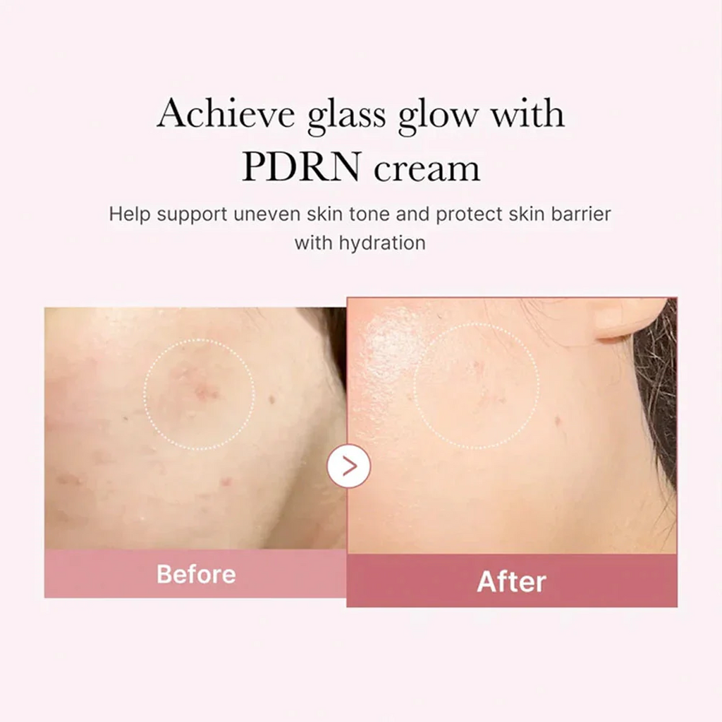 Before and After usage of Medicube PDRN Pink Hyaluronic Moisturizing Cream
